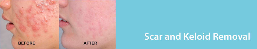 Scar and Keloid Removal
