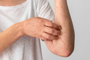 Allergies and Immunologic Skin Disorders